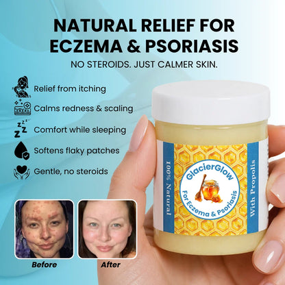 Hive & Heal - Repair Balm For Eczema & Psoriasis